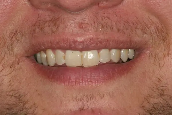 Before preventative dentistry at Flax Dental, Atlanta