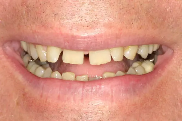 Before veneers at Flax Dental, Atlanta