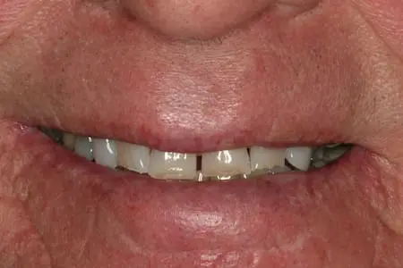 Before smile makeover at Flax Dental, Atlanta