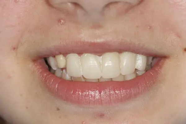 Before smile makeover and veneers at Flax Dental, Atlanta