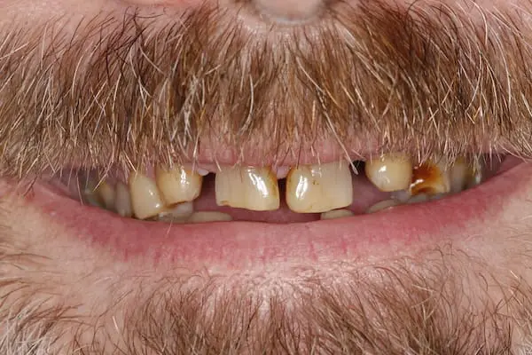 Before dental crowns, dental implants and veneers at Flax Dental, Atlanta