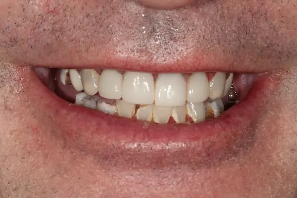 Before dental implants at Flax Dental, Atlanta