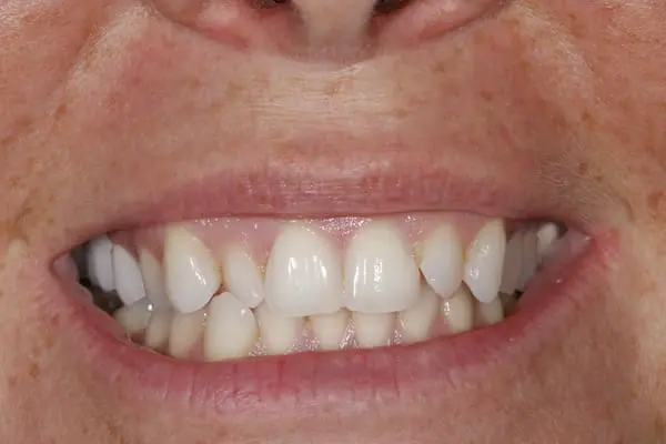 Before orthodontics and veneers at Flax Dental, Atlanta