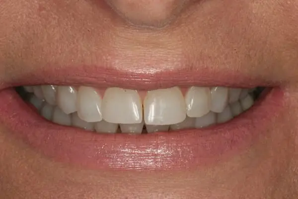 Before smile makeover at Flax Dental, Atlanta