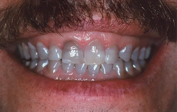 Before smile makeover at Flax Dental, Atlanta