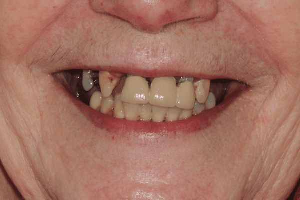 Before smile makeover at Flax Dental, Atlanta