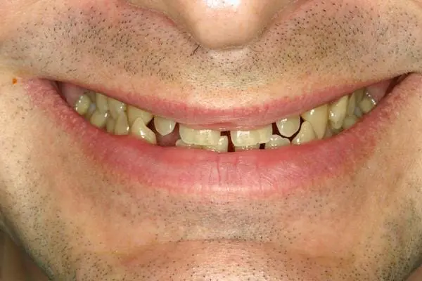 Before gum lift, orthodontics and veneers at Flax Dental, Atlanta