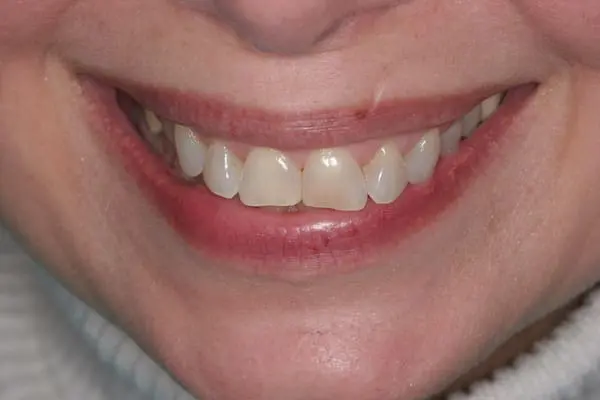 Before cosmetic dentistry at Flax Dental, Atlanta