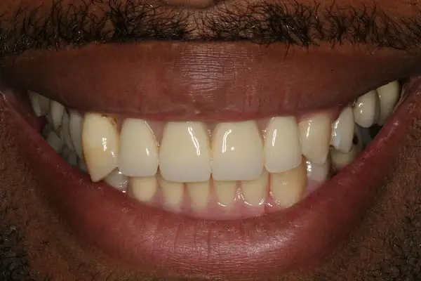 Before cosmetic dentistry at Flax Dental, Atlanta