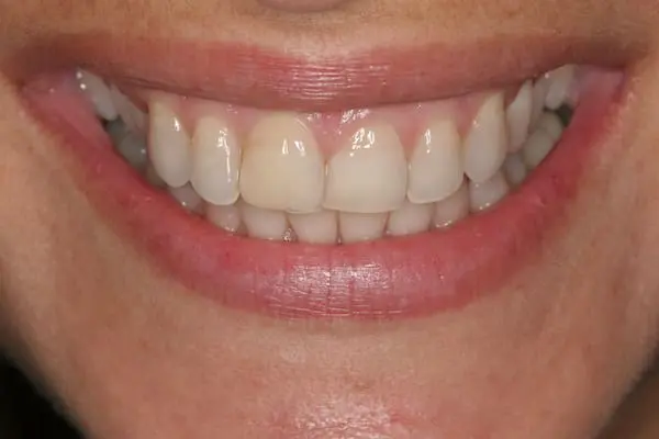 Before gum lift and veneers at Flax Dental, Atlanta