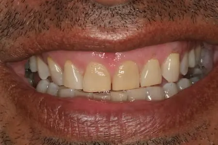 Before cosmetic dentistry at Flax Dental, Atlanta