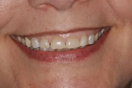 Before cosmetic dentistry at Flax Dental, Atlanta