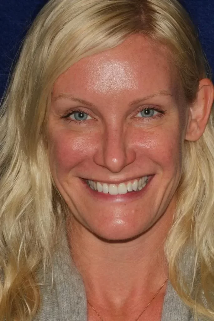 Patient portrait after teeth whitening and veneers at Flax Dental, Atlanta