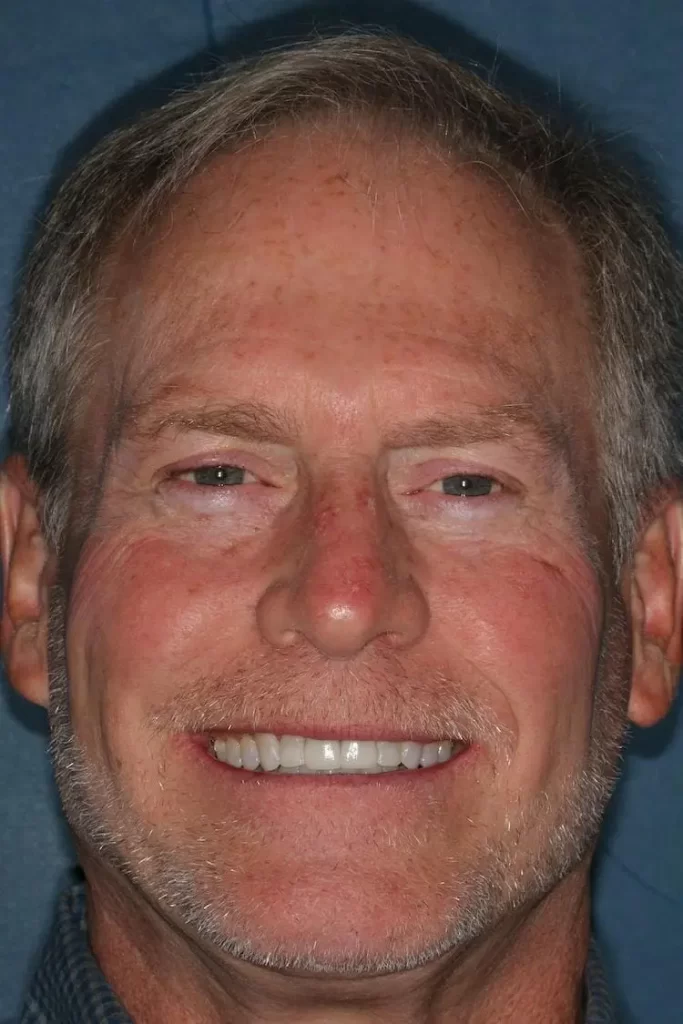 Patient portrait after bonding, orthodontics and teeth whitening at Flax Dental, Atlanta