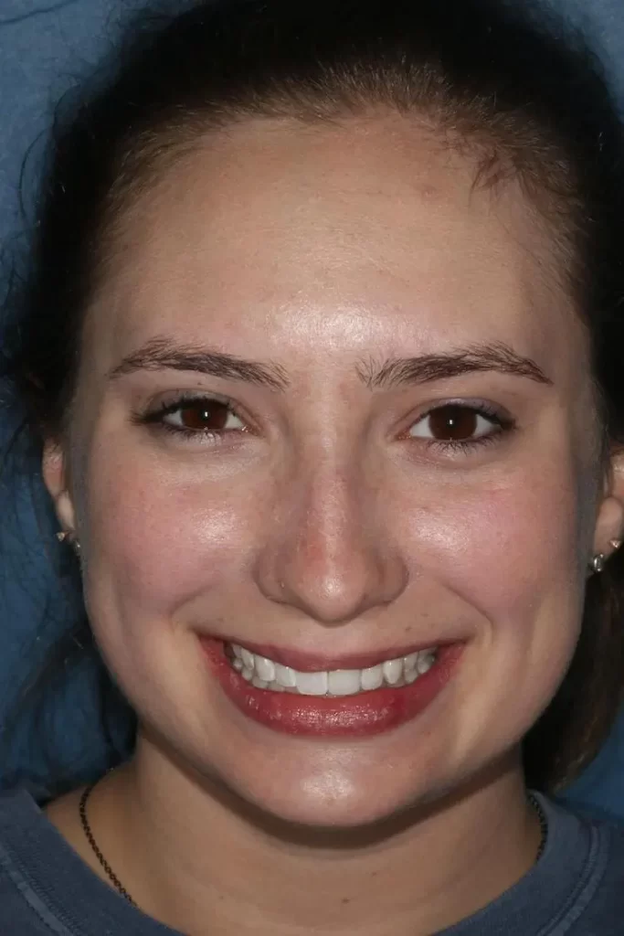 Patient portrait after bonding and orthodontics at Flax Dental, Atlanta