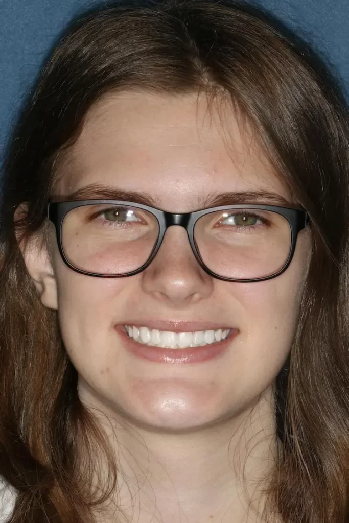 Patient portrait after bonding and teeth whitening at Flax Dental, Atlanta