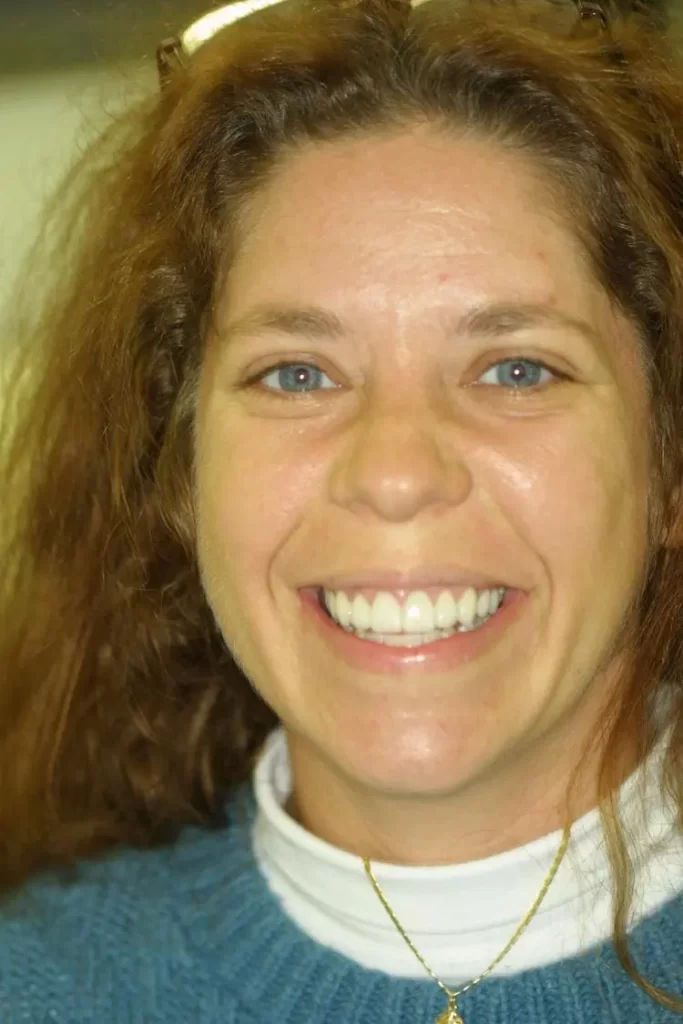 Patient portrait after dental crowns, gum lift and veneers at Flax Dental, Atlanta
