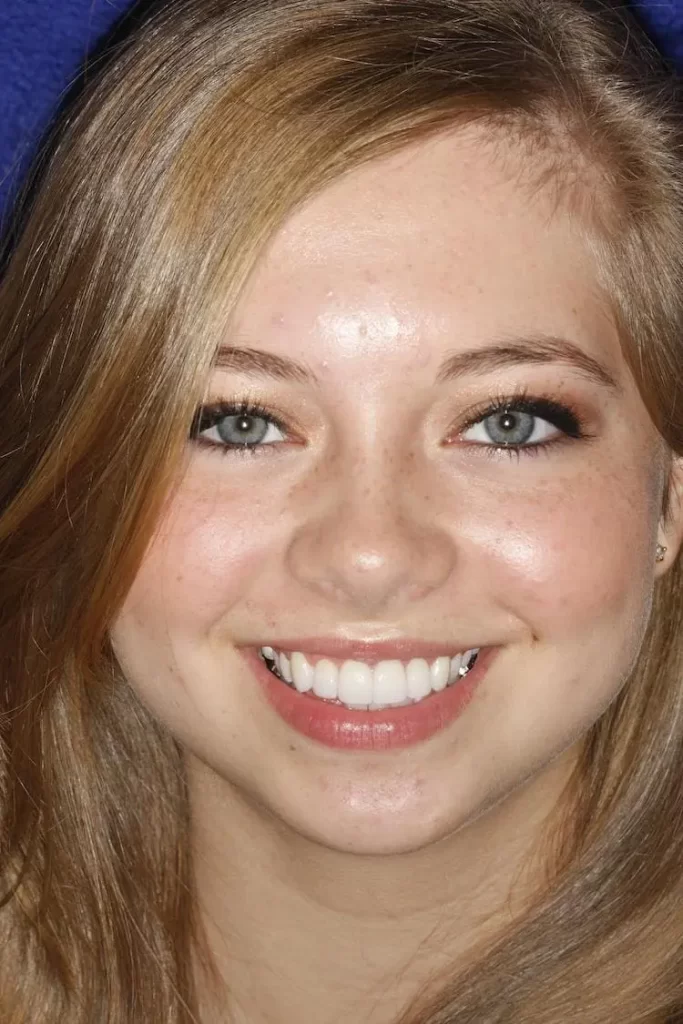 Patient portrait after smile makeover and veneers at Flax Dental, Atlanta
