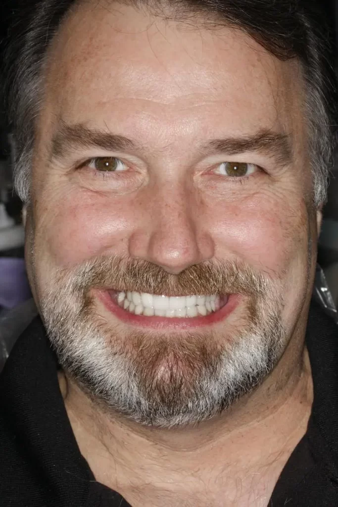 Patient portrait after dental crowns, dental implants and veneers at Flax Dental, Atlanta