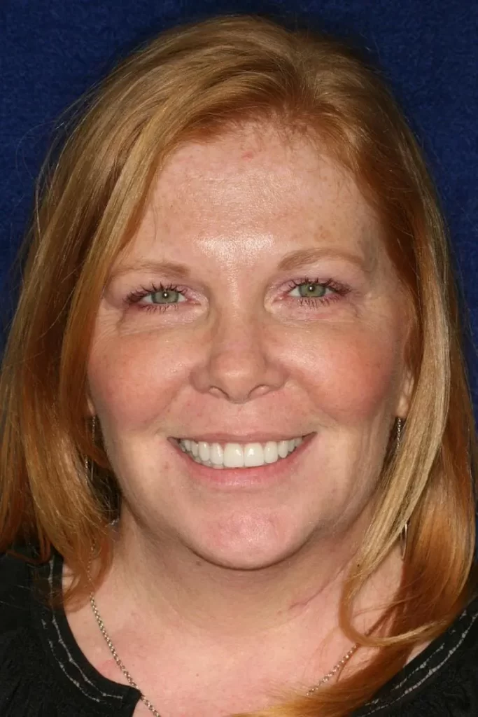 Patient portrait after orthodontics and veneers at Flax Dental, Atlanta