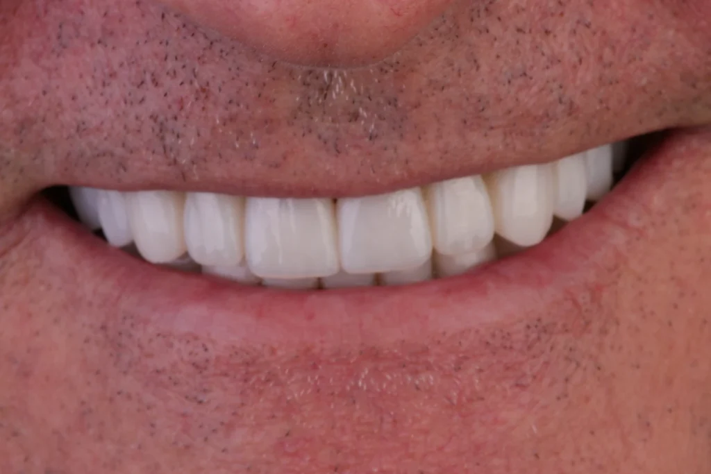 After cosmetic dentistry at Flax Dental, Atlanta