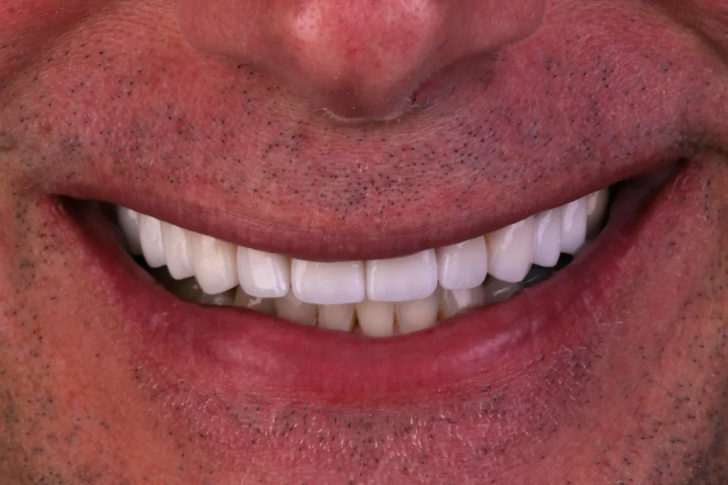 After cosmetic dentistry at Flax Dental, Atlanta