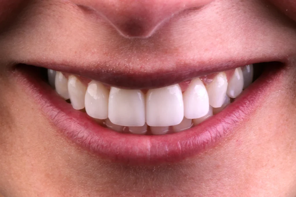 After cosmetic dentistry at Flax Dental, Atlanta