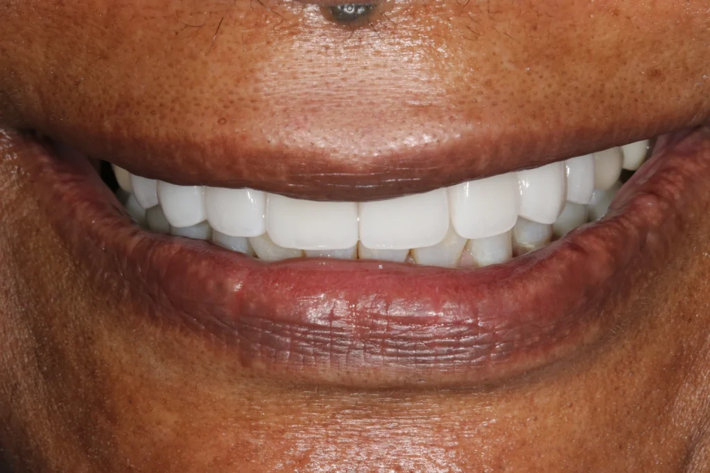 After cosmetic dentistry at Flax Dental, Atlanta