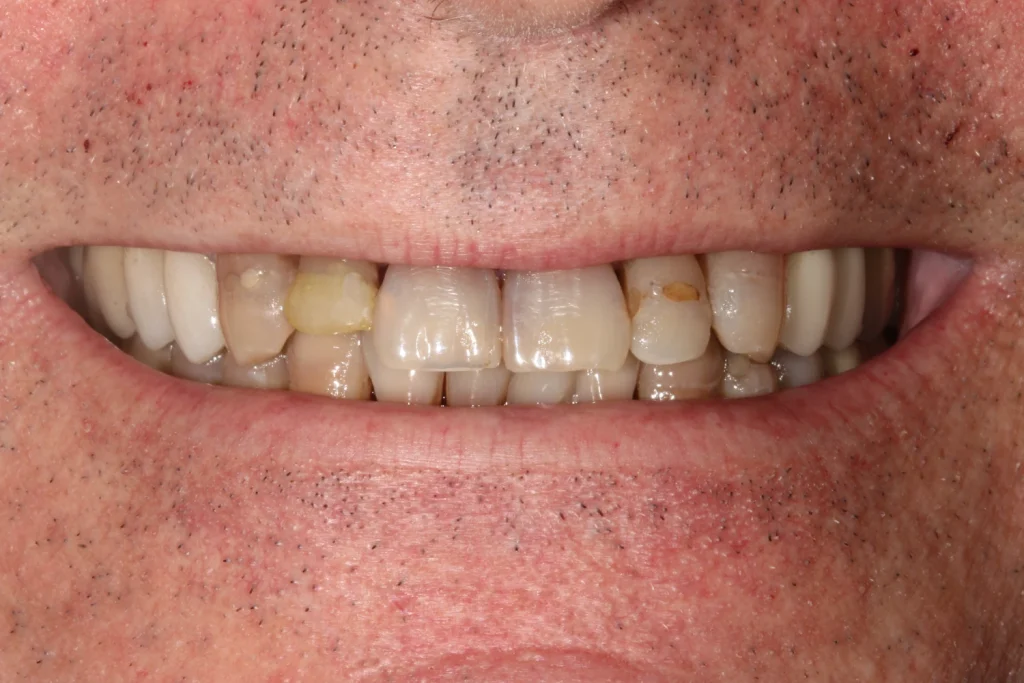 Before cosmetic dentistry at Flax Dental, Atlanta