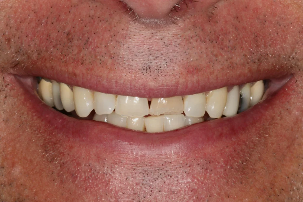 Before cosmetic dentistry at Flax Dental, Atlanta