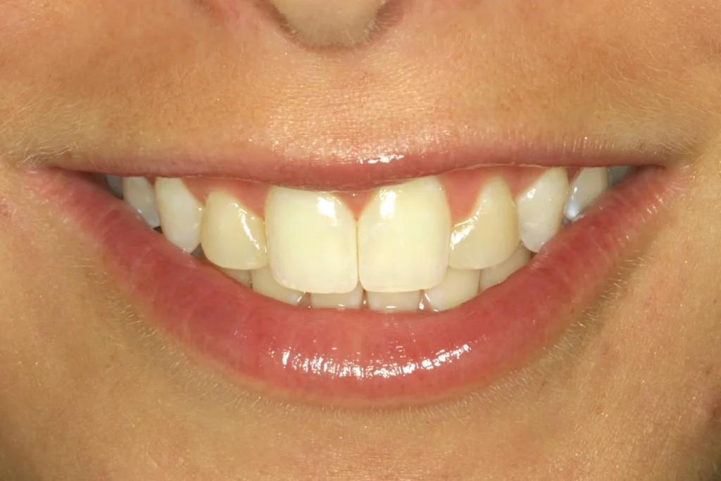 Before cosmetic dentistry at Flax Dental, Atlanta