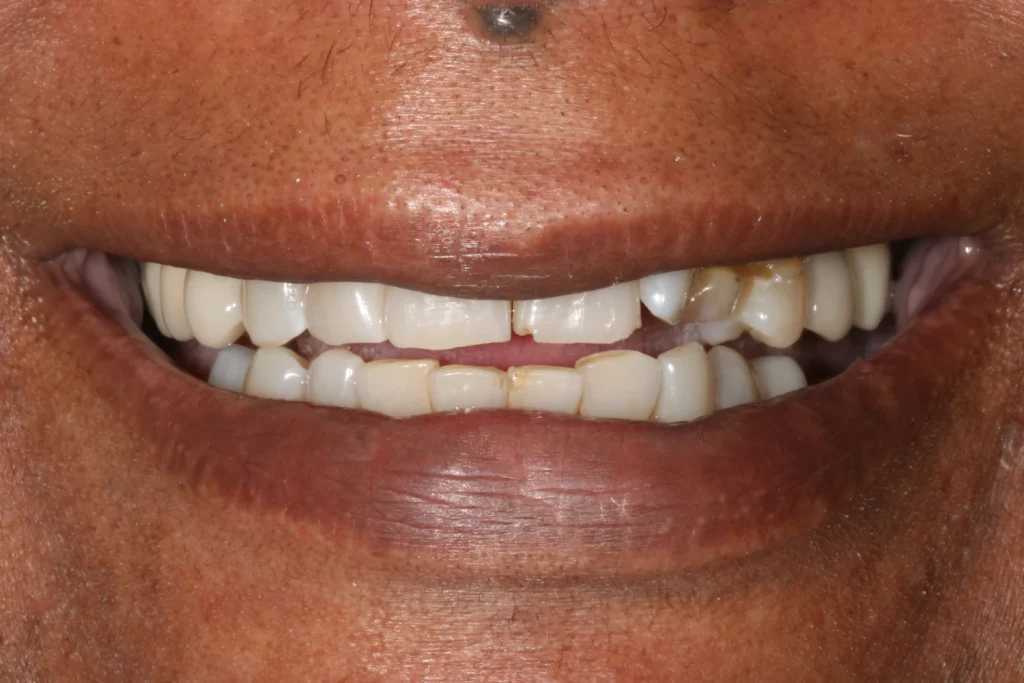Before cosmetic dentistry at Flax Dental, Atlanta